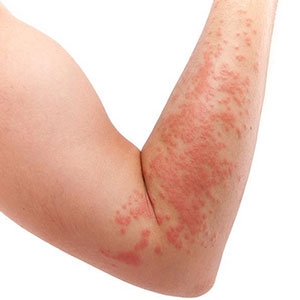 Auvi-Q in Canada? Your Anaphylaxis Emergency Plan Just Got a Game-Changer.