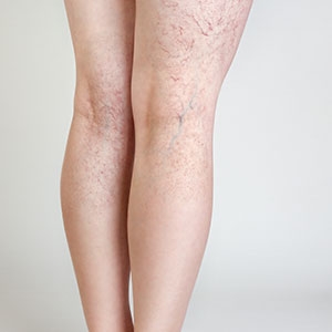 Your Search for Excellent and Affordable Vein Treatment in South Florida Ends Here